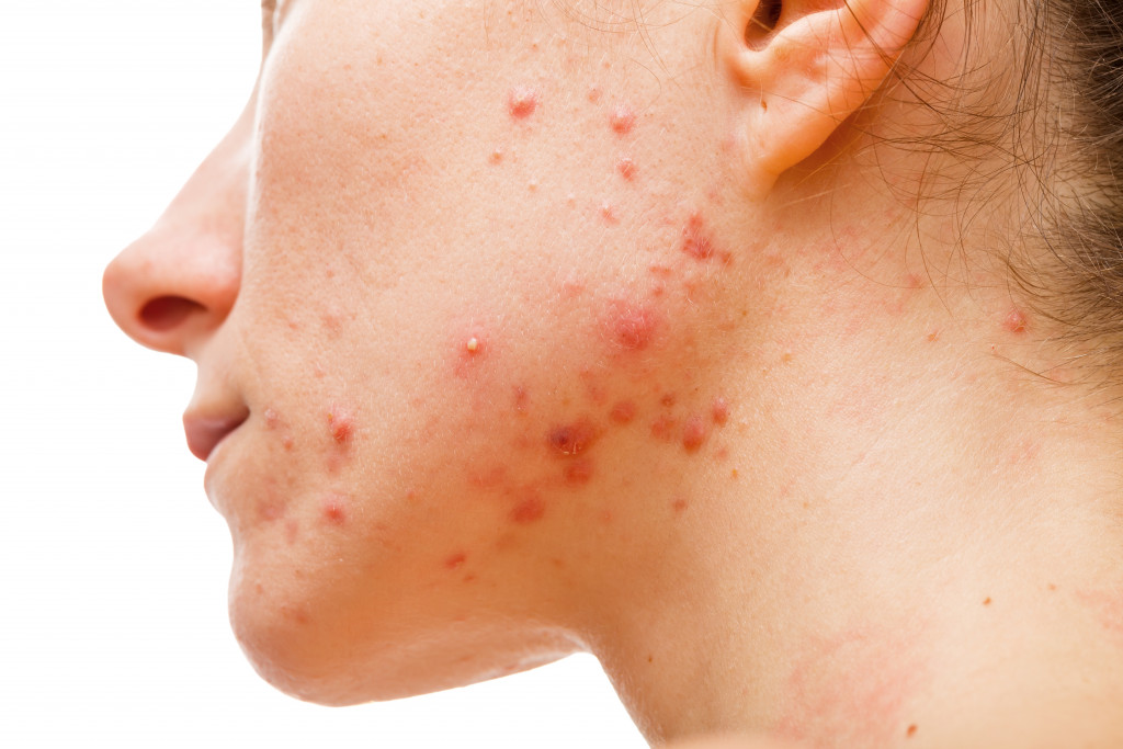 Acne on woman
